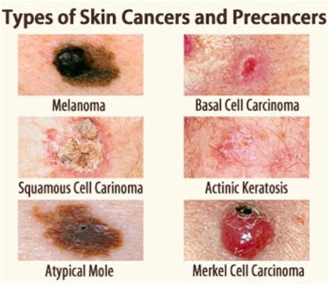 What Types Of Skin Cancer Are There