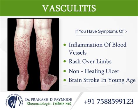 Vasculitis - Dr.PrakashPaymode