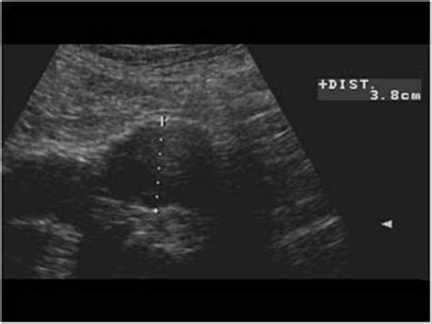 Peripheral vessels | 10.1 Peripheral arteries : Case 10.1.5 Peripheral ...