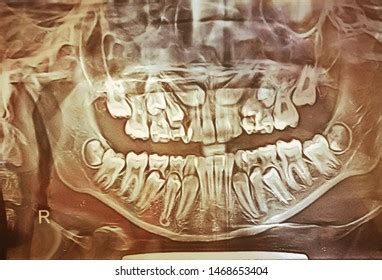 Radiograph Mixed Dentition Royalty-Free Images, Stock Photos & Pictures ...