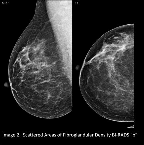 Your patient got a dense breast notification with her mammogram report ...