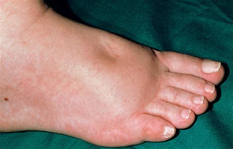 What Causes Swollen Feet In Diabetes?