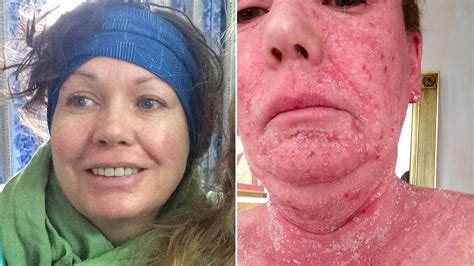 This Woman's Skin Peeled Off Due to Her Topical Steroid Cream Addiction ...