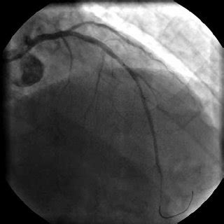 After second bare metal stent implantation, there is no more contrast ...