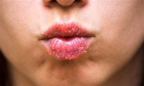 Dry Lip Treatments: 3 Ways to Treat Your Client’s Chapped Lips ...