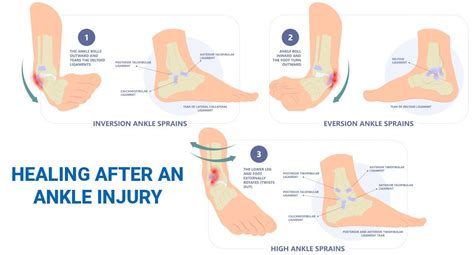 How to Heal a Ankle Injury using Sprain Ankle Treatment