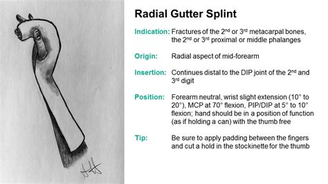 Radial Gutter Splint Pattern