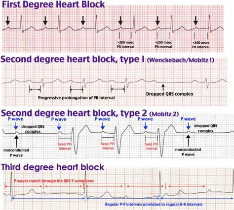 Commonly Found Symptoms of Heart Blockage in Males