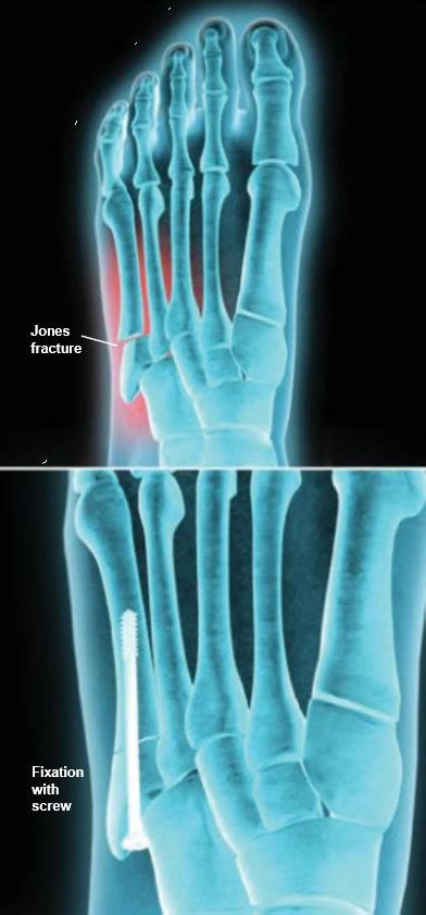 Jones Fracture Fixation | Central Coast Orthopedic Medical Group