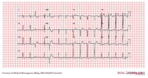 Left ventricular hypertrophy EKG examples - wikidoc