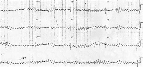 Ventricular Fibrillation Ecg Monitor