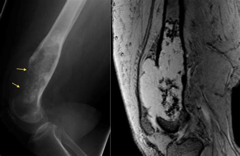 Chondrosarcoma - Radiology at St. Vincent's University Hospital