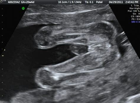 20+6 scan - girl or boy? | BabyCenter