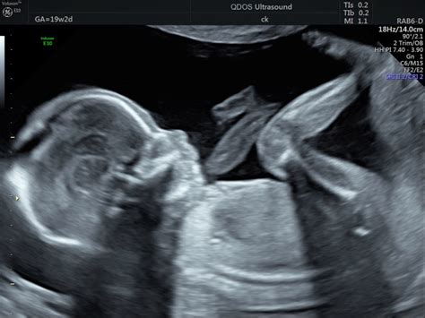 19 Week Scan Perth | Mid-trimester Ultrasound | Pregnancy Scan | Perth