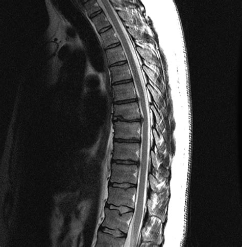 Herniated Disc Thoracic Mri