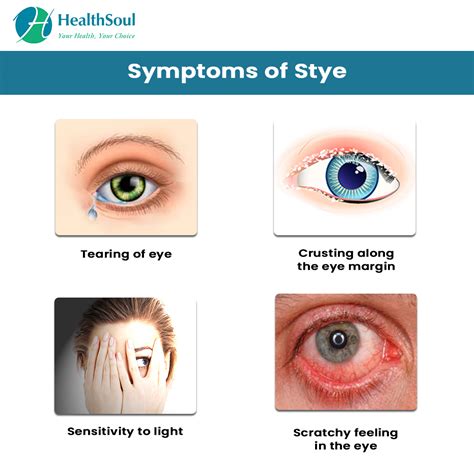 Stye : Causes and Treatment – Healthsoul