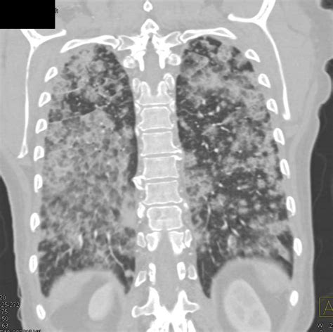 Diffuse Alveolar Infiltrates due to Hemorrhage - Chest Case Studies ...