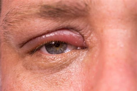 Chalazion: Bump on Eyelid Causes & Treatment - The Eye News