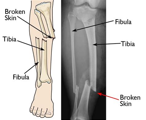 Infections After Fracture - OrthoInfo - AAOS