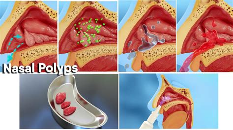 Nasal polyps treatment and surgery! 3d medical animation|Dandelion Team ...