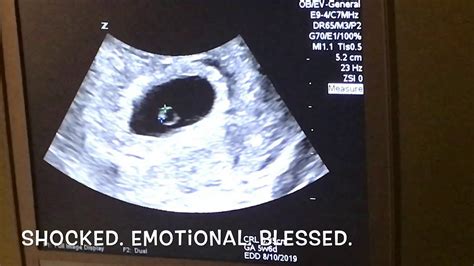 Ultrasound 5 Weeks Pregnant With Twins Belly - pregnantbelly