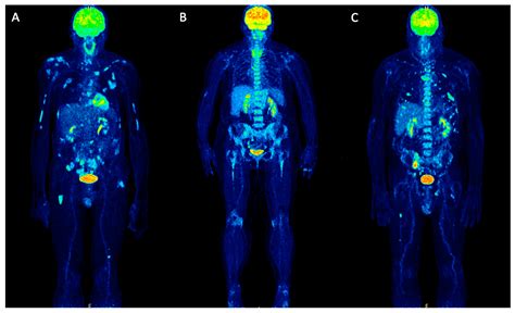 a positron emission tomography pet scan depicts brain activity by ...