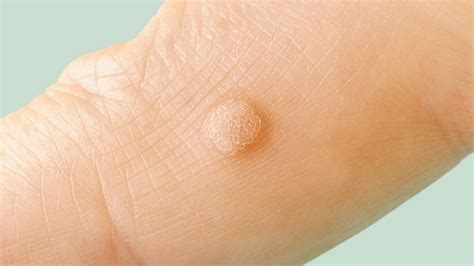 How To Detect Warts - Punchtechnique6