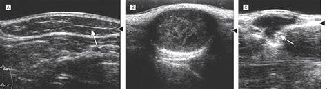 Efficacy of Diagnostic Ultrasonography of Lipomas, Epidermal Cysts, and ...