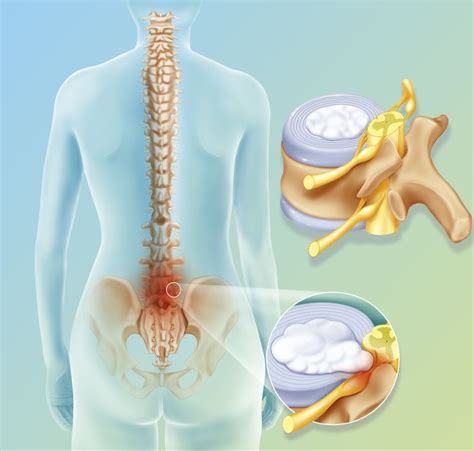 Bulging and Slipped Disc Symptoms