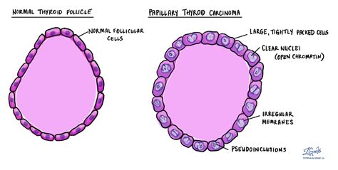 Papillary thyroid carcinoma - MyPathologyReport.ca