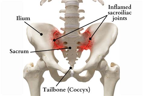 Causes Of Sacrum Pain