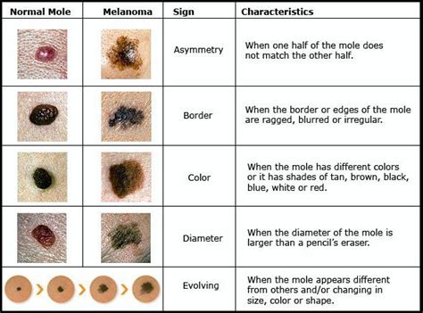 Dog Skin Cancer Black Spot Pictures | Dog Skin Cancer Black Spot