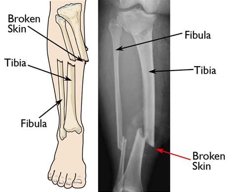 Open vs closed fracture - allyJuli