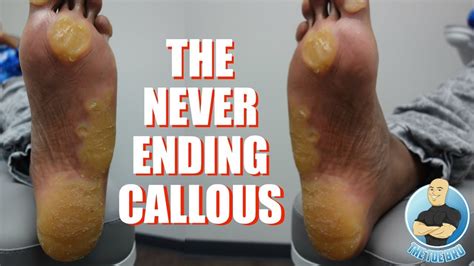 EXTREME UNBELIEVABLE NEVER ENDING THICKEST FOOT CALLUS/CALLOUS REMOVAL ...