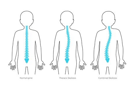 Scoliosis Symptoms and treatment - little growing bones