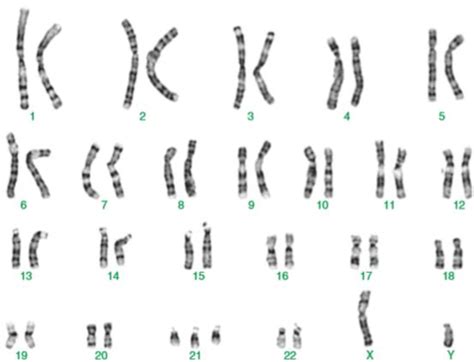 Translocation Down Syndrome Karyotype