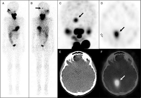 Cerebellar Metastasis From Thyroid Carcinoma With Prominent ...