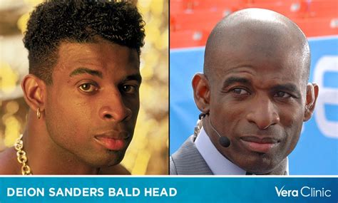 Deion Sanders Bald Head: A Journey of the Iconic Athlete