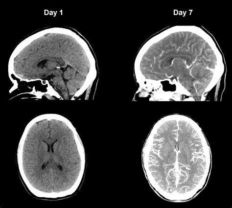 Successful outcome of Epstein–Barr virus encephalitis managed with ...