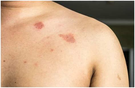 Nummular Eczema vs Ringworm - Symptoms, Causes, Diagnosis, Treatment ...