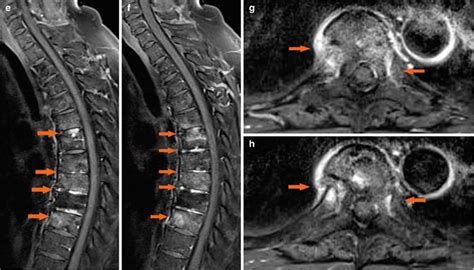 Ankylosing Spondylitis | Radiology Key