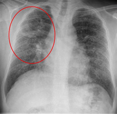 Cureus | Mycobacterium Kansasii Infection and Microscopic Polyangiitis ...