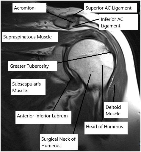 Rotator Cuff Tear Mri