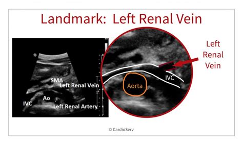 Abdominal Ultrasound for Echocardiographers: Branches of the Aorta ...