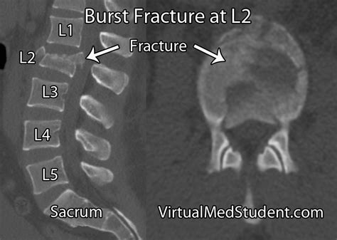 What Is A Lumbar Spine Fracture - Design Talk