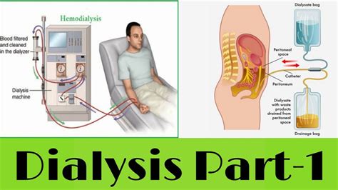 Dialysis- types, method and basic info - YouTube