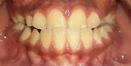 Crossbite: Types, Effects, & Corrective Measures