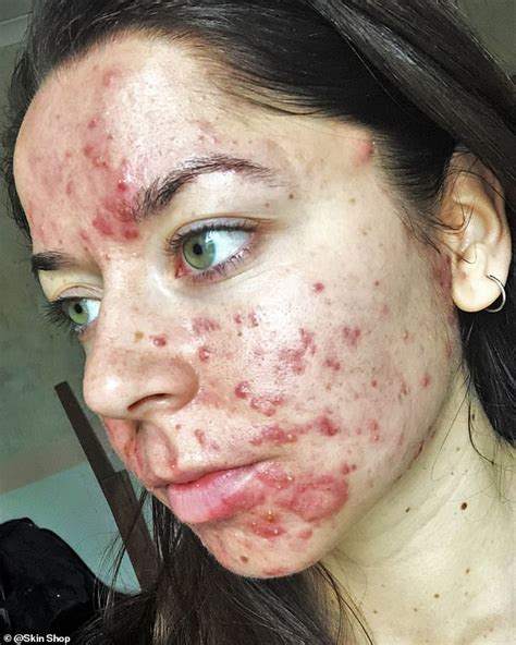 Woman bullied at school due to acne has seen DRAMATIC improvements ...