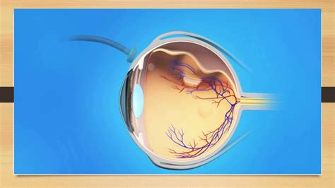 Diabetic Retinopathy Part 5| Laser, Injection & Surgical options for DR ...