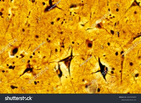 Human Cerebral Cortex Neurofibrillary Tangles Pyramidal Stock Photo ...